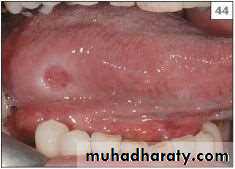 Ulcer
