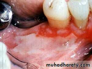 Ulcer