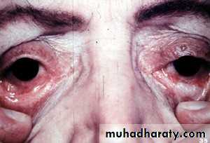 Ulcer