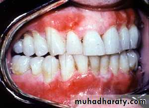 Ulcer
