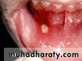 Ulcer