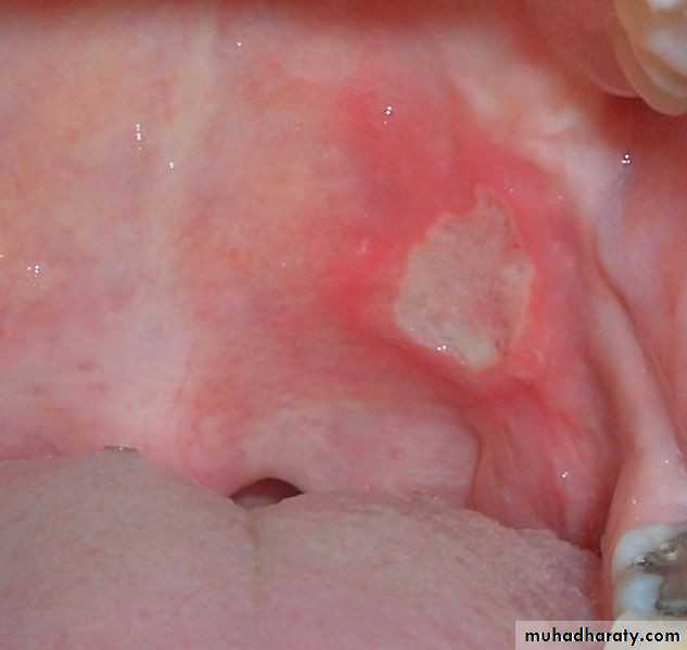 Ulcer