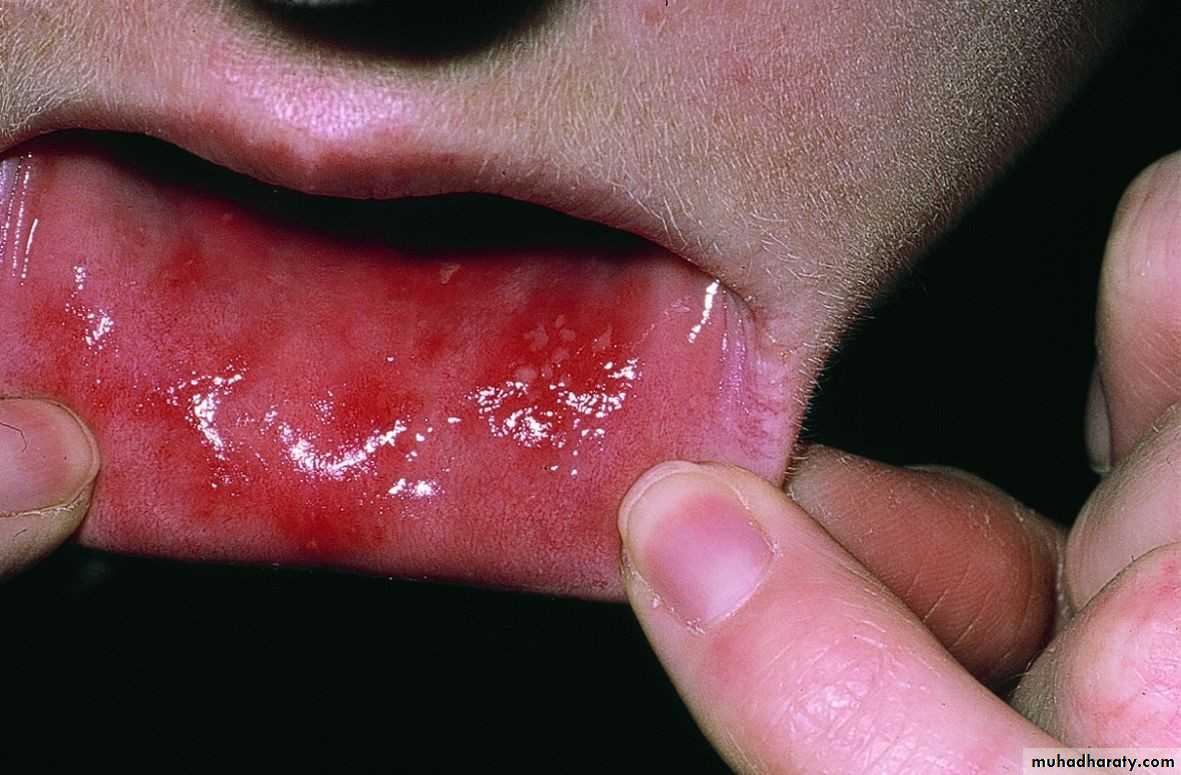 Ulcer