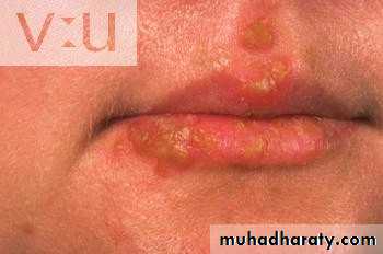 Ulcer