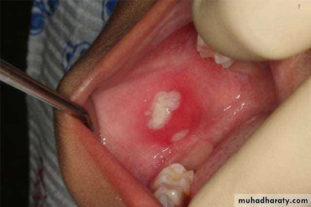 Ulcer