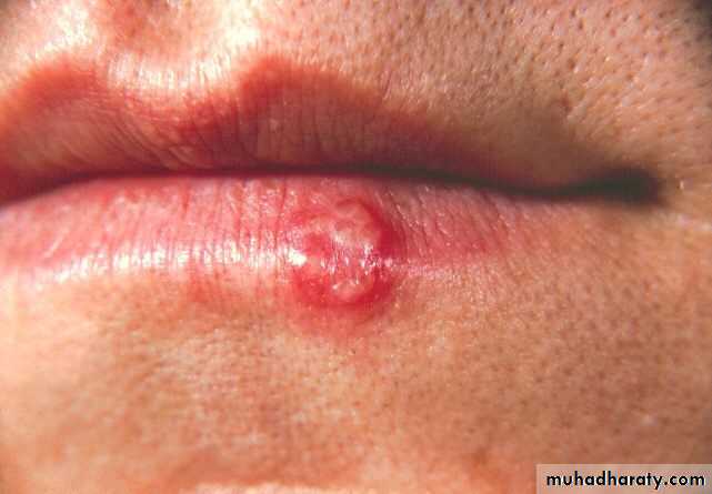 Ulcer