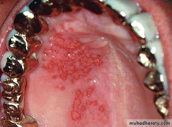 Ulcer