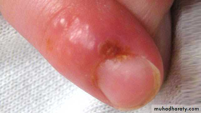 Ulcer
