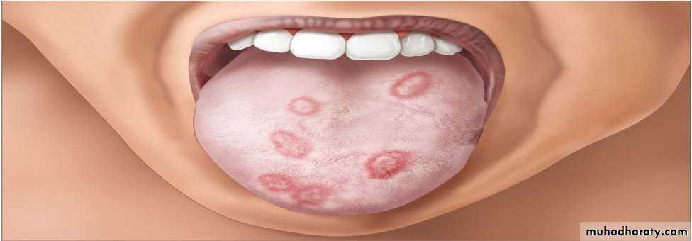 Ulcer