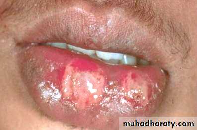 Ulcer