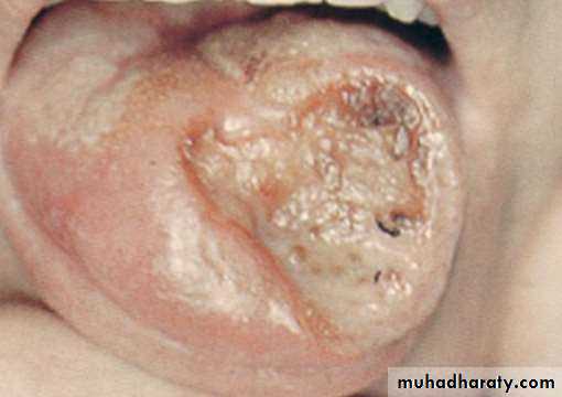 Ulcer