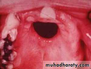 Ulcer