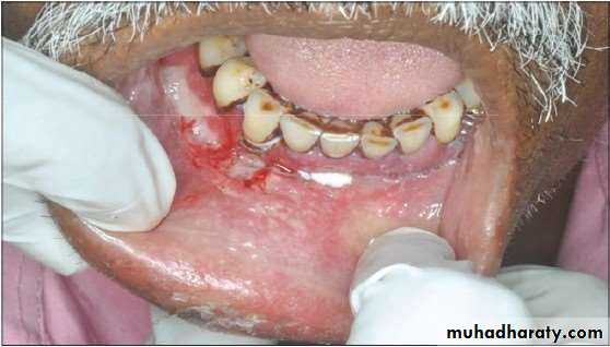 Ulcer