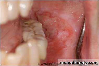 Ulcer