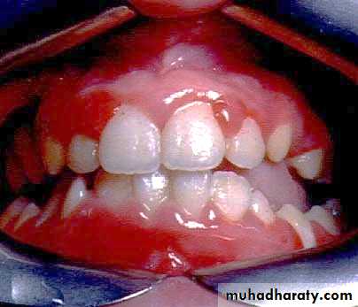 Ulcer