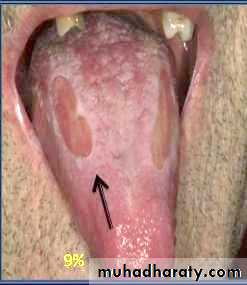 Ulcer