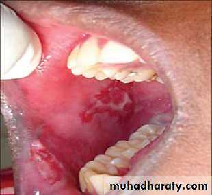 Ulcer