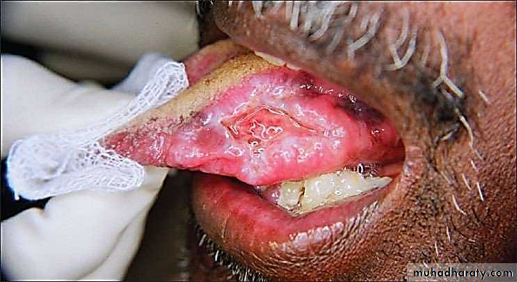 Ulcer