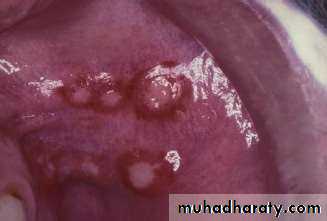 Ulcer