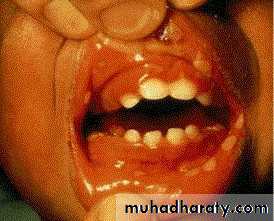 Ulcer