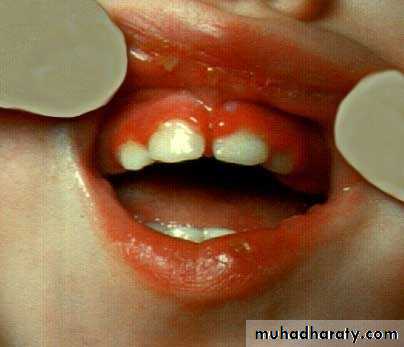 Ulcer