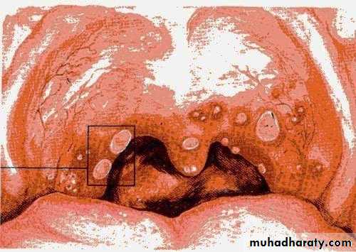 Ulcer
