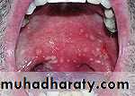 Ulcer