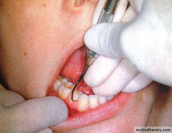 periodontal instruments