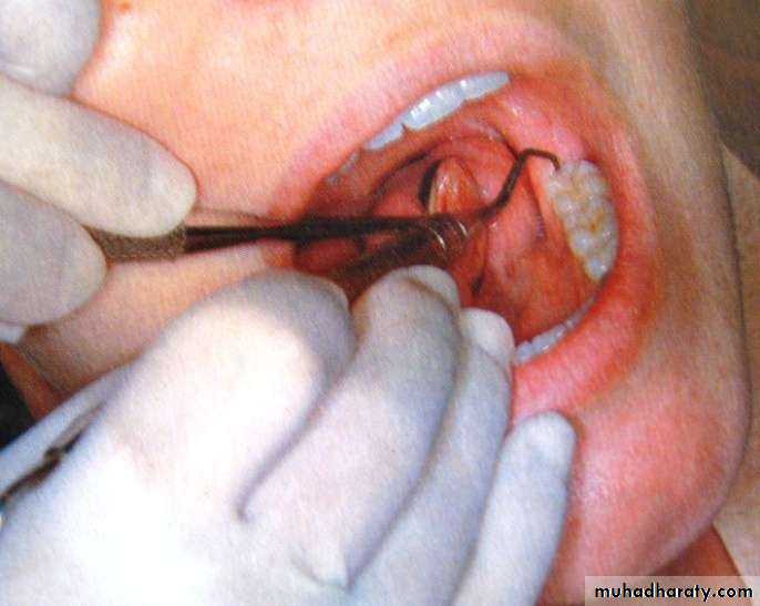 periodontal instruments