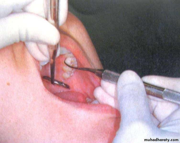 periodontal instruments