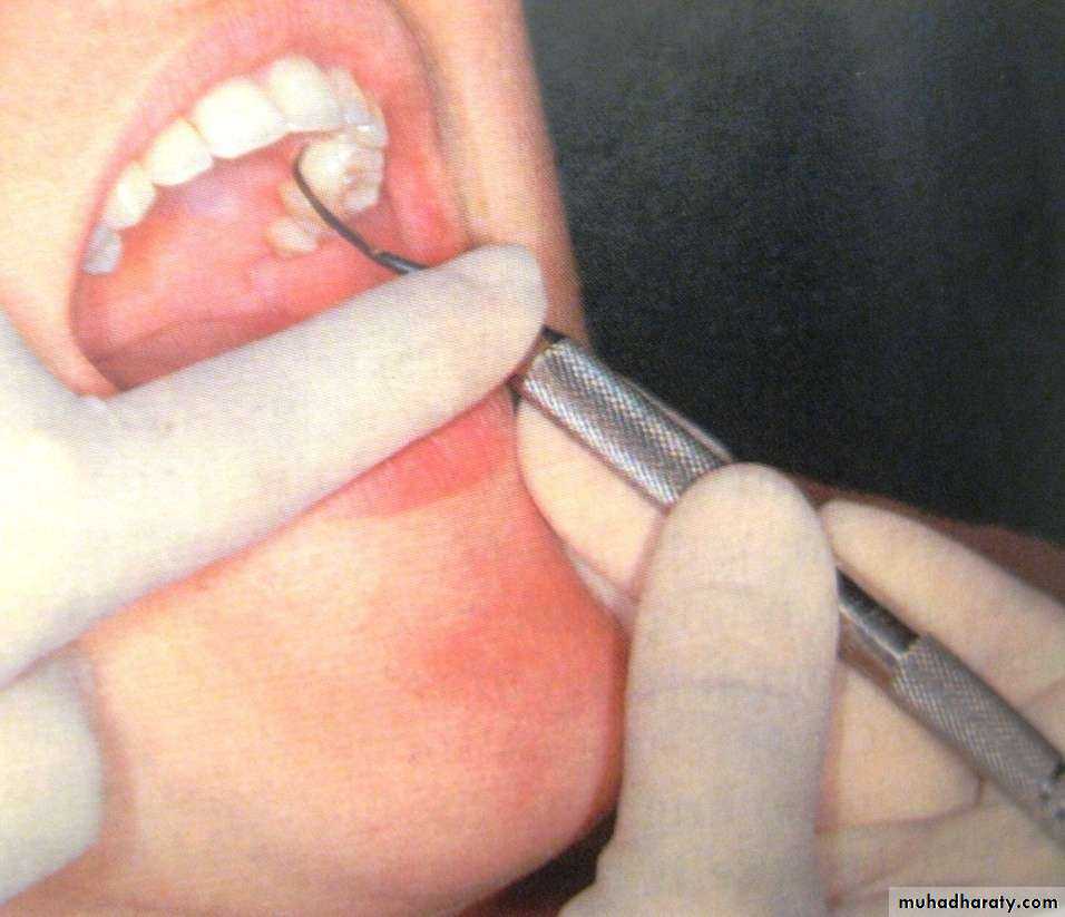 periodontal instruments