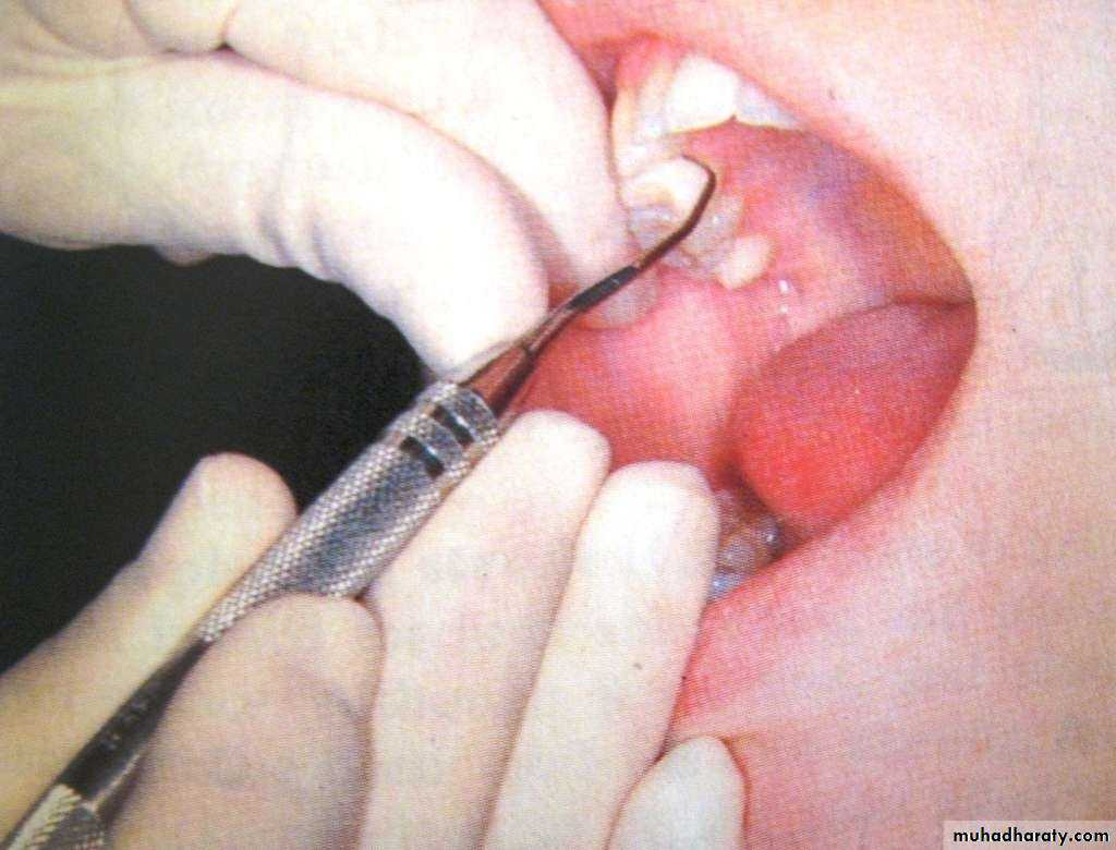periodontal instruments