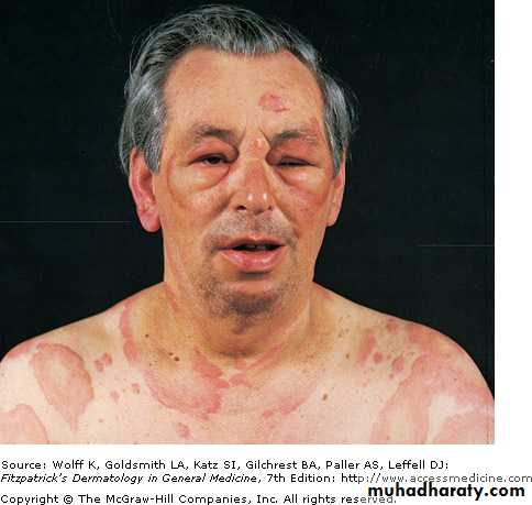 Urticaria