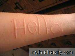 Urticaria