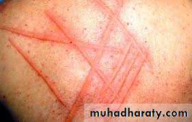 Urticaria