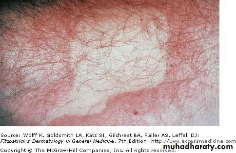Urticaria