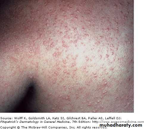Urticaria