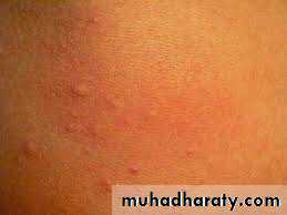 Urticaria