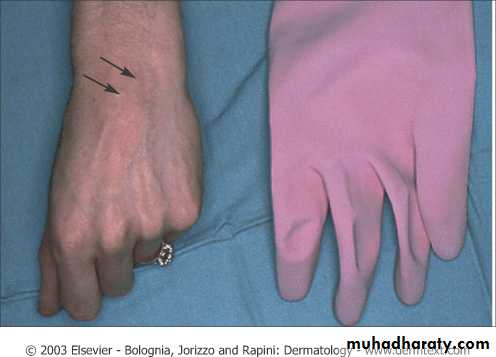 Urticaria