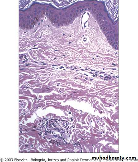 Urticaria