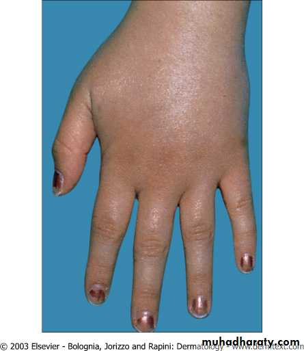 Urticaria