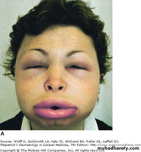 Urticaria
