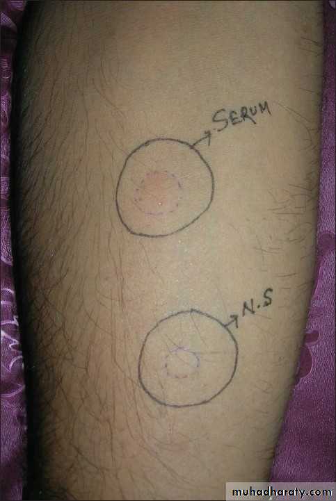 Urticaria
