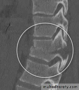 Spine Fractures