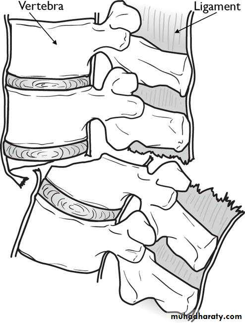 Spine Fractures