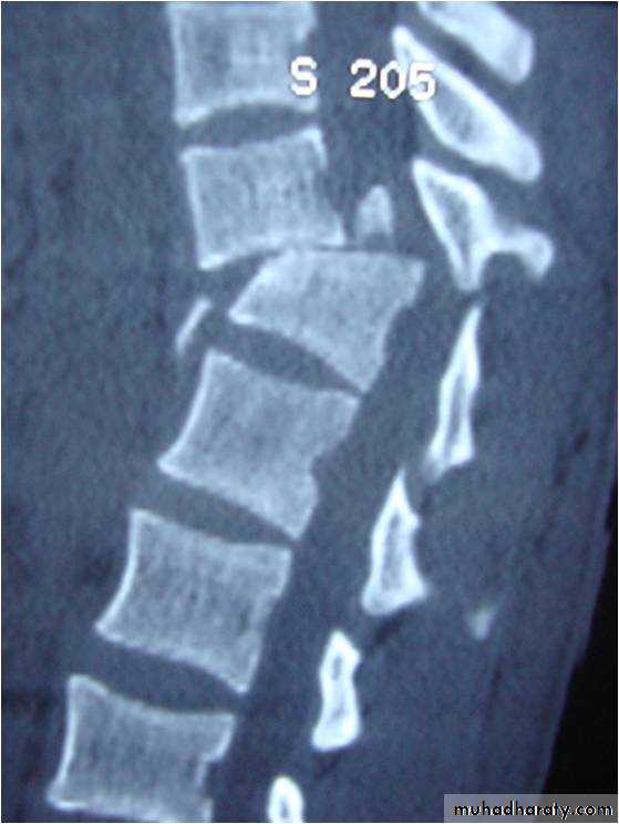 Spine Fractures