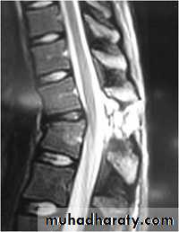 Spine Fractures