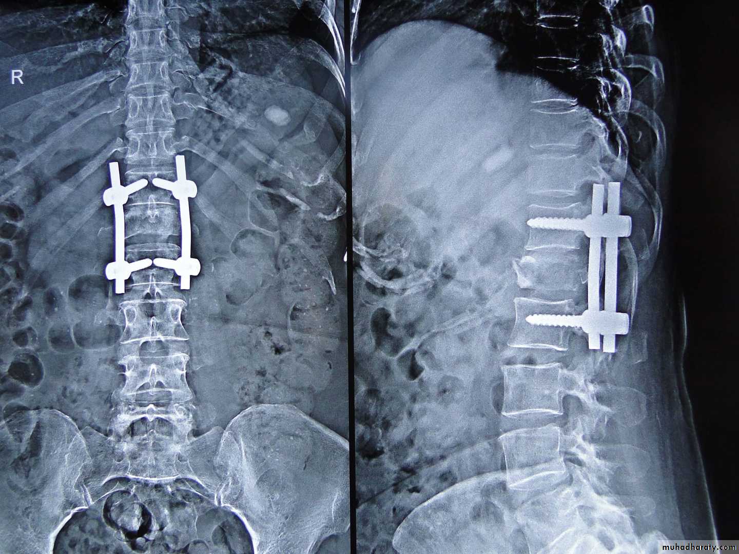 Spine Fractures