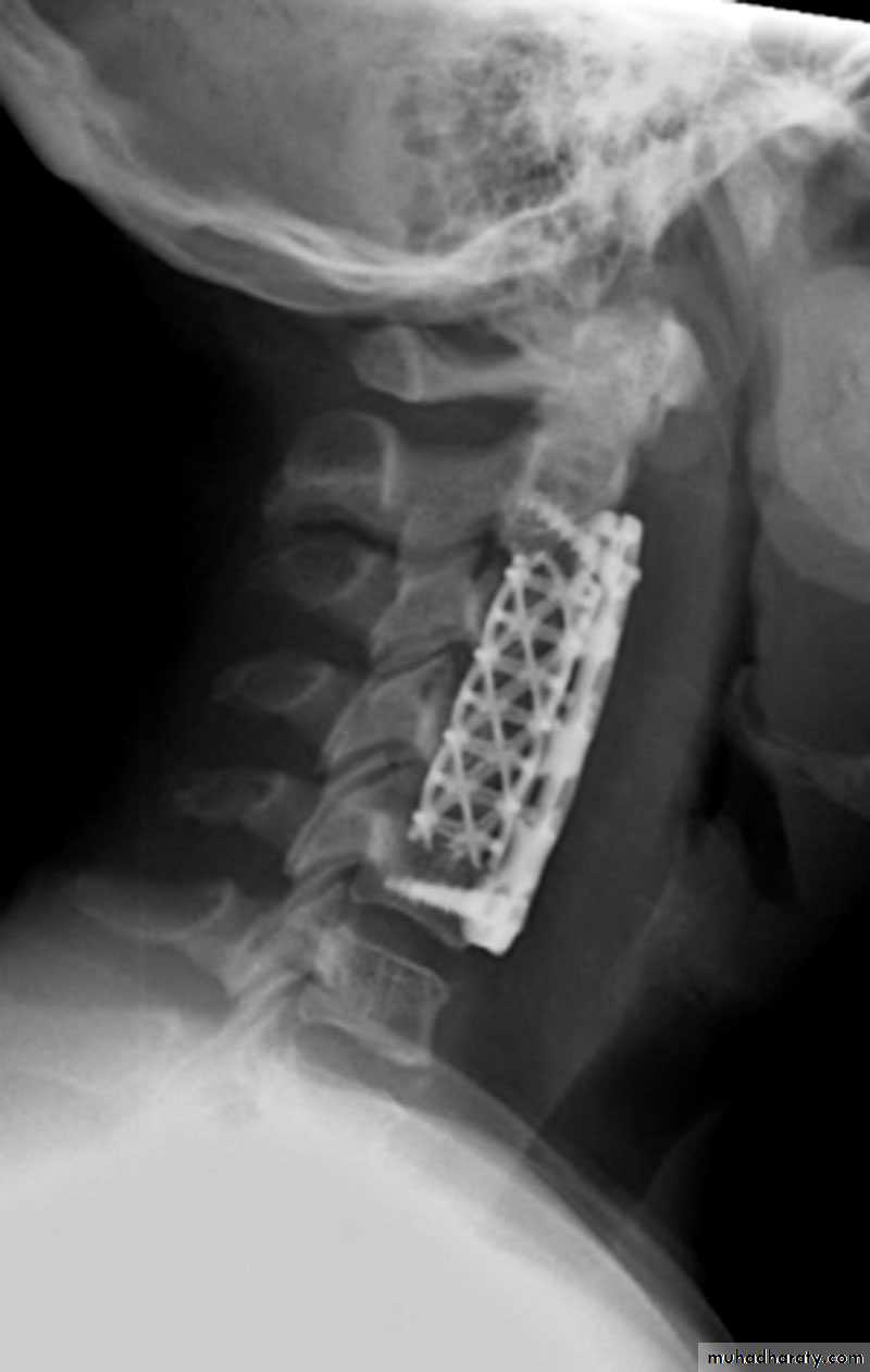 Spine Fractures