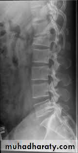 Spine Fractures